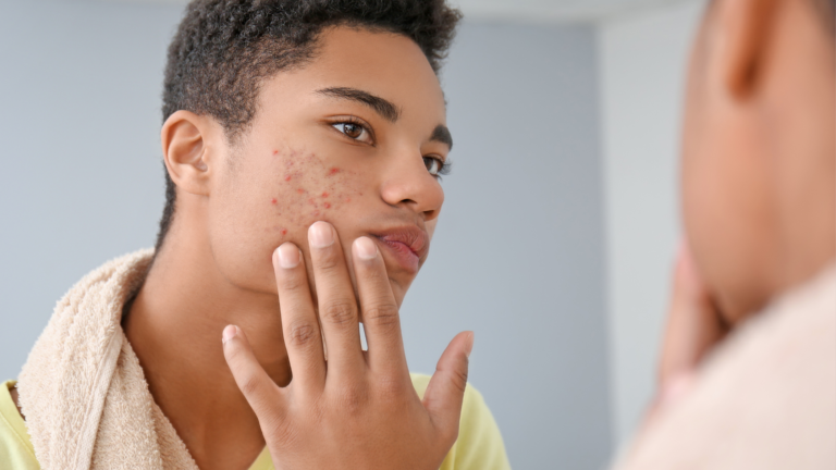 Close-up of clear, healthy skin after acne treatment using BBL and microneedling therapies.